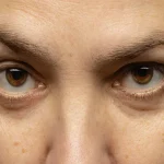 The Science Behind Effective Dark Eye Circle Removal