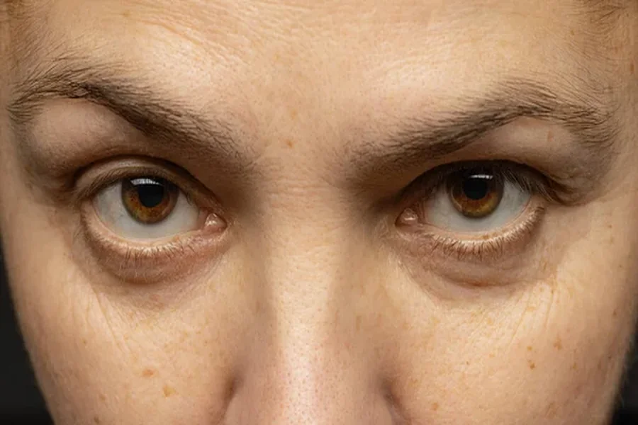 The Science Behind Effective Dark Eye Circle Removal