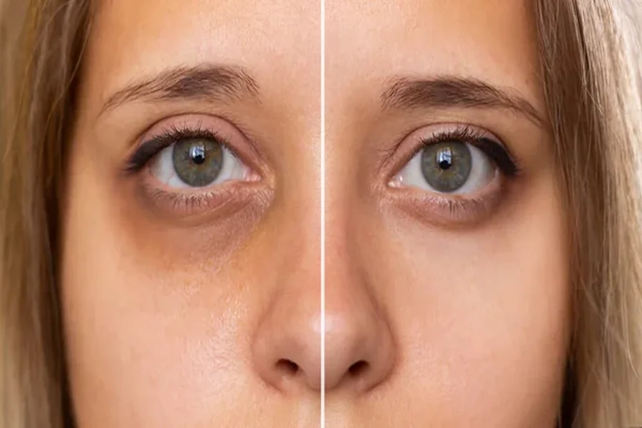 Dark Eye Circle