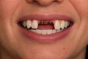 From One Missing Tooth to Multiple Missing Teeth: Your Best Options